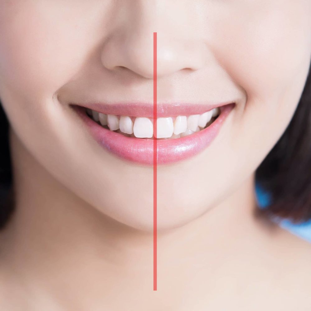 Állcsontdeformitás