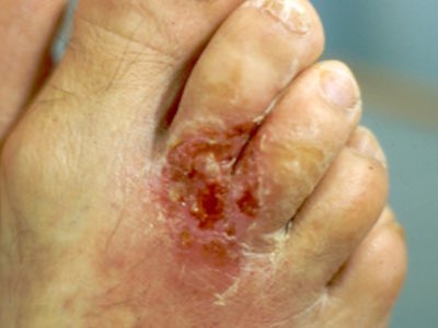 üszkösödés lábak kezelés cukorbetegség)