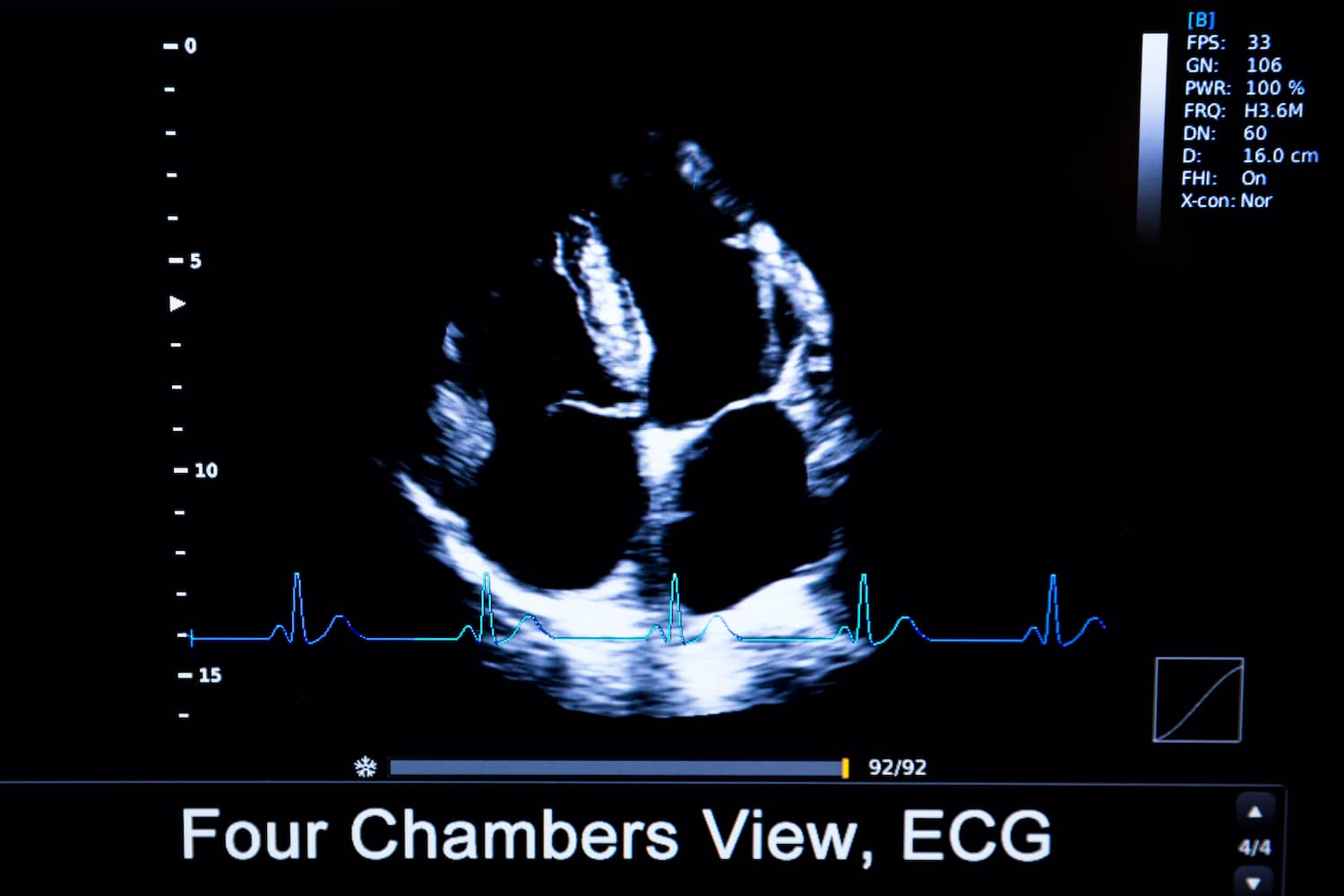 Kardiológia- szív ultrahang