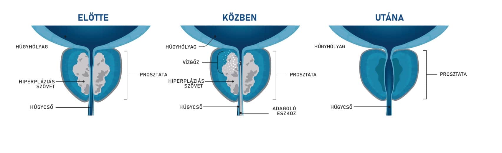 Rezüm kezelés